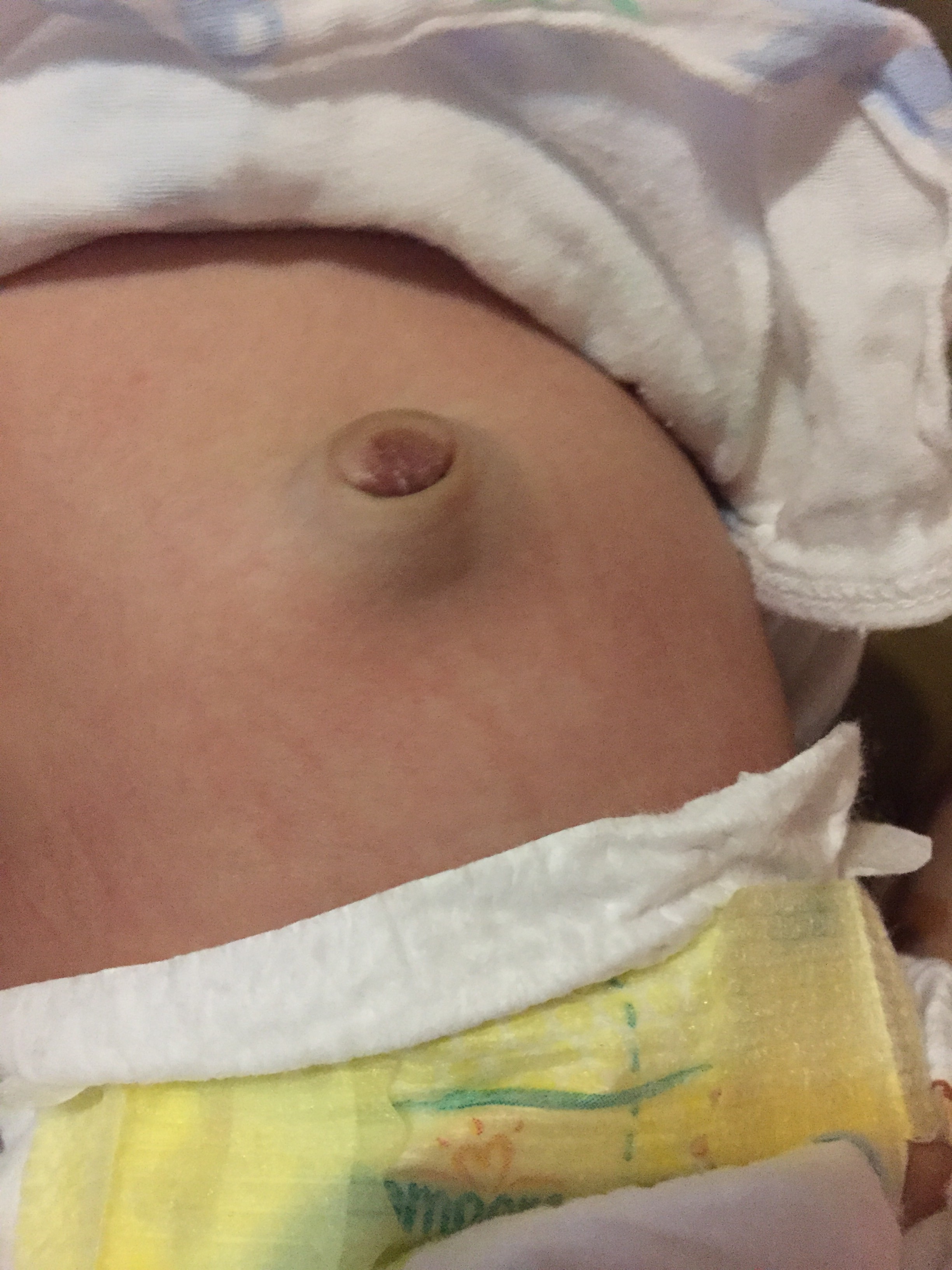 新生兒凸肚臍正常嗎？-求助發問