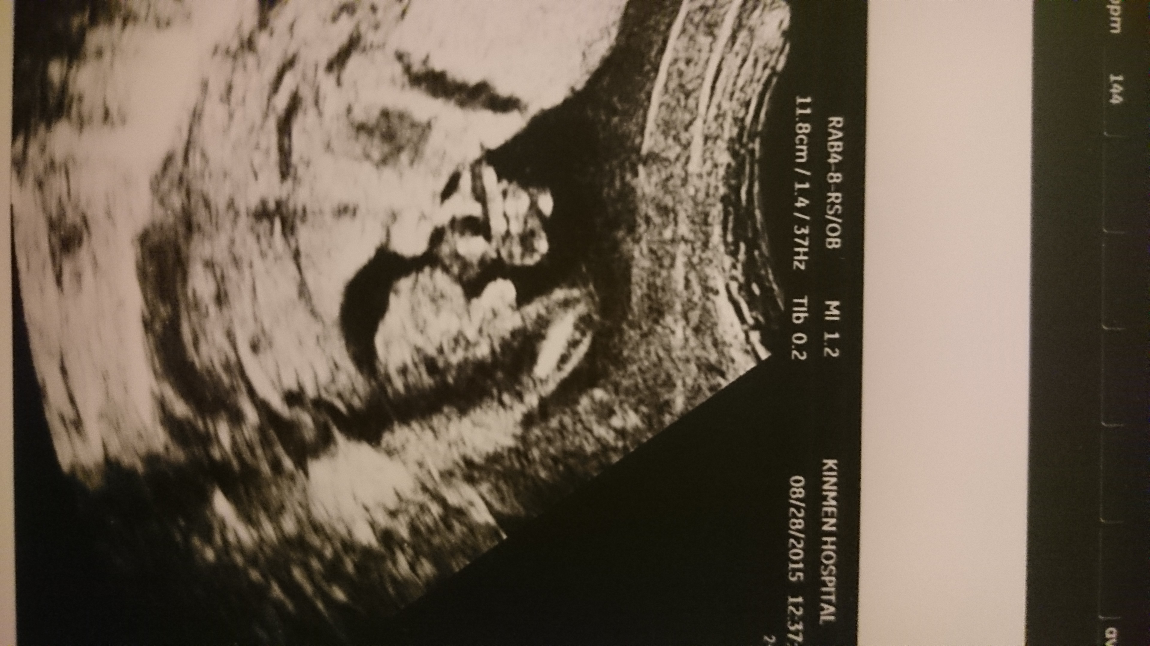 16週是弟弟超音波 18週醫生又不確定性別 附超音波照 非常婚禮verywed