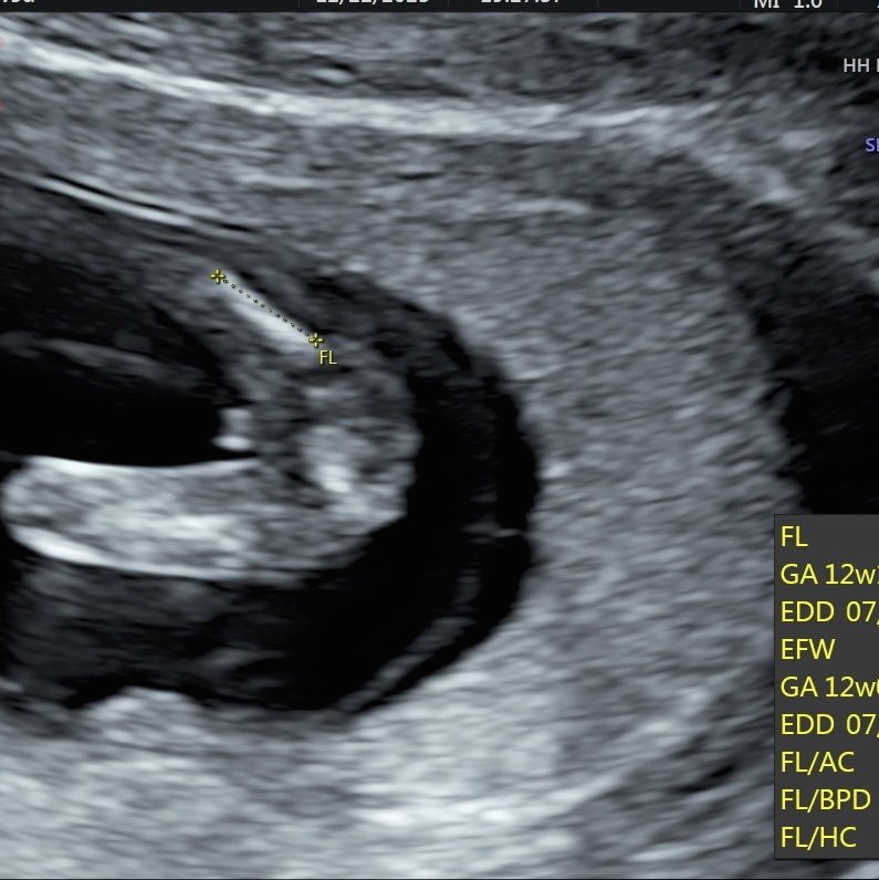 超音波是男寶還女寶-婚姻經營